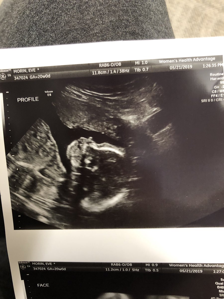 juliaemorin's tweet photo. Of all of the gifts life has to offer, YOU by far are the greatest one 💙💜❤️ we’re half way there baby 🤞🏼🧸🍼 #20weekstogo https://t.co/ltIBDss0J5