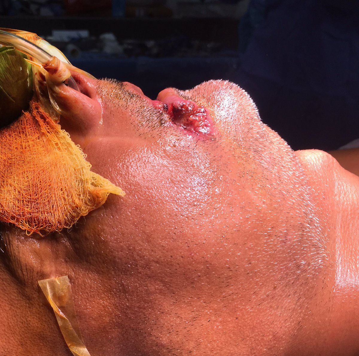 DrJMughal's tweet photo. Removing large #OralCancer right cheek, upper & lower lips, on 42yrs male (cable operator), due to Gutka & Chhali!
Will involve neck dissection & reconstruction using muscle from scalp.
Can watch step by step on #snapchat @DrJMughal
#NOTOGUTKA #Karachi https://t.co/STqeP39luE