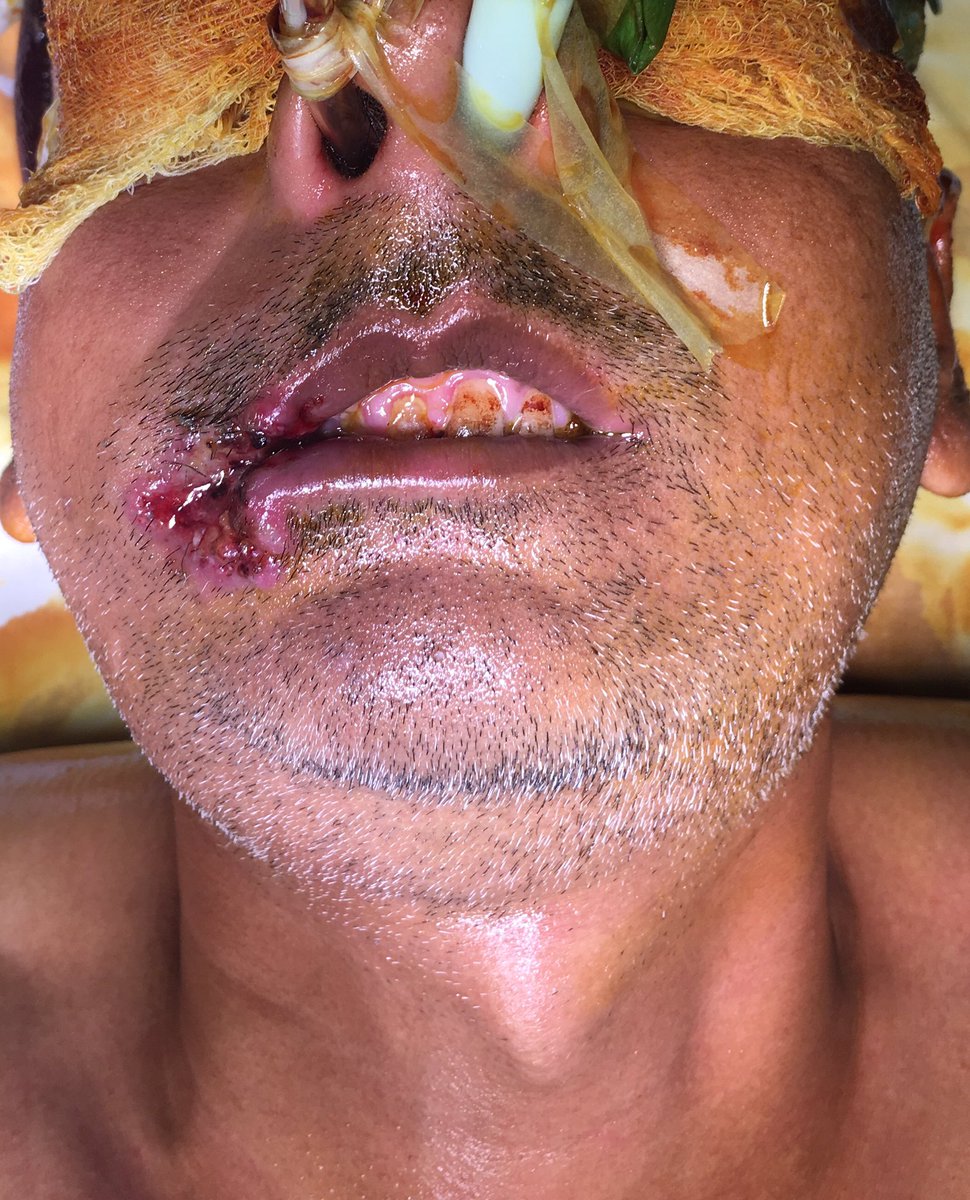 DrJMughal's tweet photo. Removing large #OralCancer right cheek, upper & lower lips, on 42yrs male (cable operator), due to Gutka & Chhali!
Will involve neck dissection & reconstruction using muscle from scalp.
Can watch step by step on #snapchat @DrJMughal
#NOTOGUTKA #Karachi https://t.co/STqeP39luE