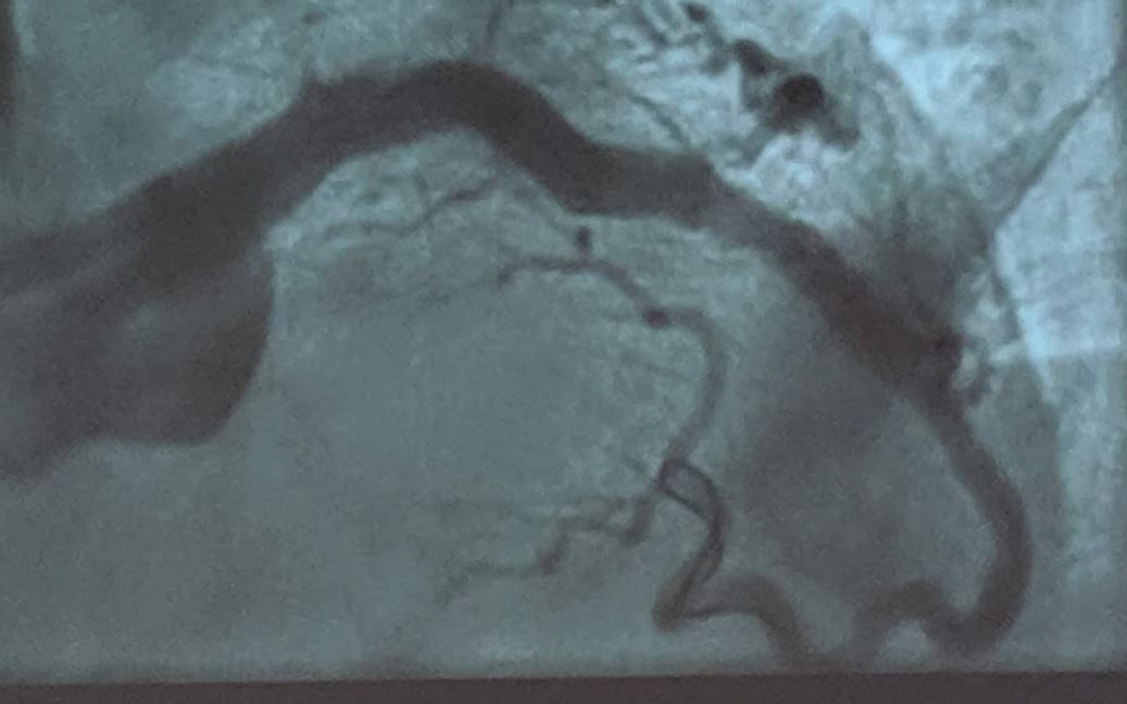 ShockwaveIVL's tweet image. Great #RotaShock #EuroPCR live case from @JEscaned &amp;amp; Nieves Gonzalo at #HospitalSanCarlos in dense, eccentric calcium, with @DrthierryL on the monitor! Perfect example of complementary use of #Rota &amp;amp; #IVL #CrossAndCrack @PCRonline  ISI bit.ly/2s7zs7j  #CardioTwitter