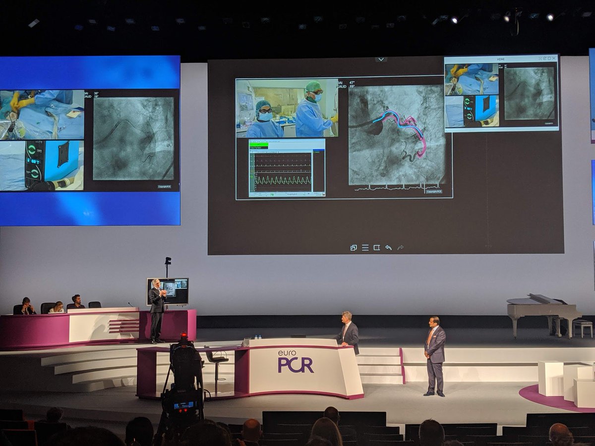 ShockwaveIVL's tweet image. Great #RotaShock #EuroPCR live case from @JEscaned &amp;amp; Nieves Gonzalo at #HospitalSanCarlos in dense, eccentric calcium, with @DrthierryL on the monitor! Perfect example of complementary use of #Rota &amp;amp; #IVL #CrossAndCrack @PCRonline  ISI bit.ly/2s7zs7j  #CardioTwitter