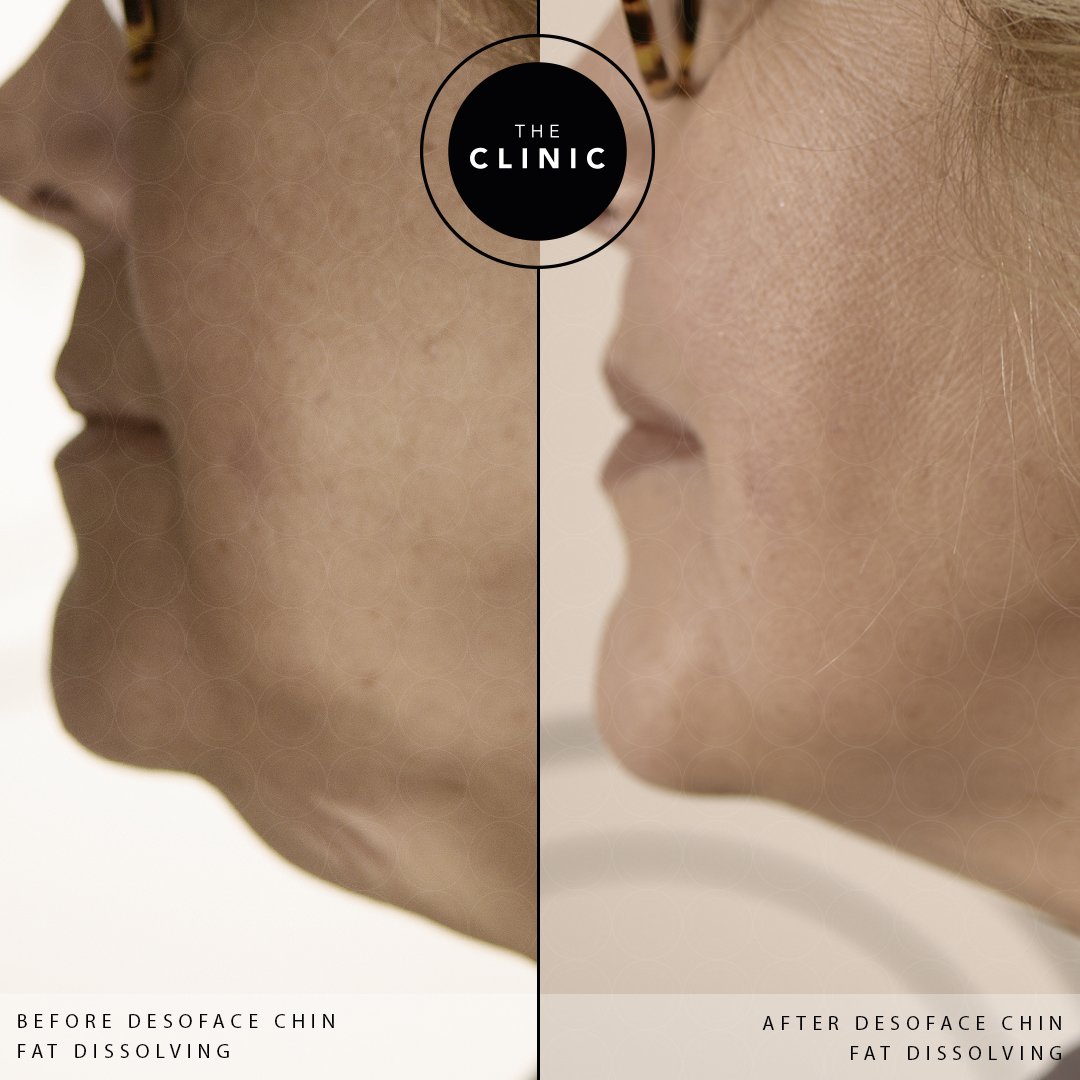 theclinicburton's tweet photo. DESOFACE
We can dissolve your double chin! No really, we can! Although the before photo is slightly blurry you can still see what an incredible result the after photo is! If you'd like some more information on this, please message us or call us on 01283 205533
#desoface https://t.co/k5DkpWhvrq
