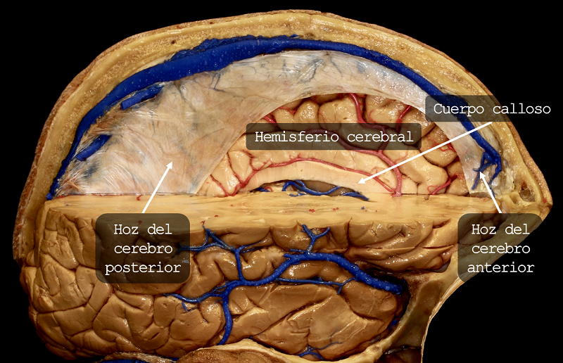 aeducar's tweet photo. Superficie cerebral medial 🧠
✅ | Leer: https://t.co/OxeQjtBqfq
✒️ | Autor: Dr. Facundo Rodríguez, Médico Neurocirujano.
#anatomia #neuroanatomia #sistemanervioso #cerebro #lobuloscerebrales #lobulofrontal #lobuloparietal #lobulooccipital #lobulotemporal #asociacioneducar https://t.co/qkL0ng2yWg