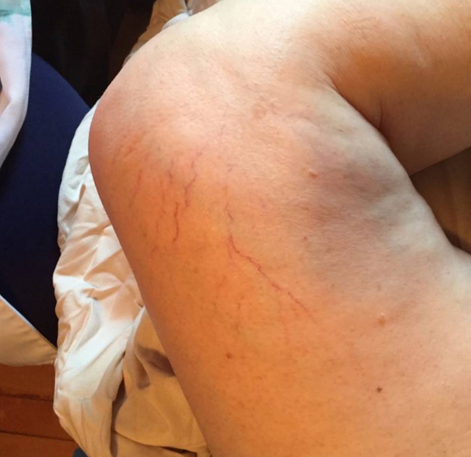 Does spider veins have you dreading the warmer months?  We get it and we have the answer! Give us a call today to discuss! (845) 47-DERMA  dermalasercenterny.com