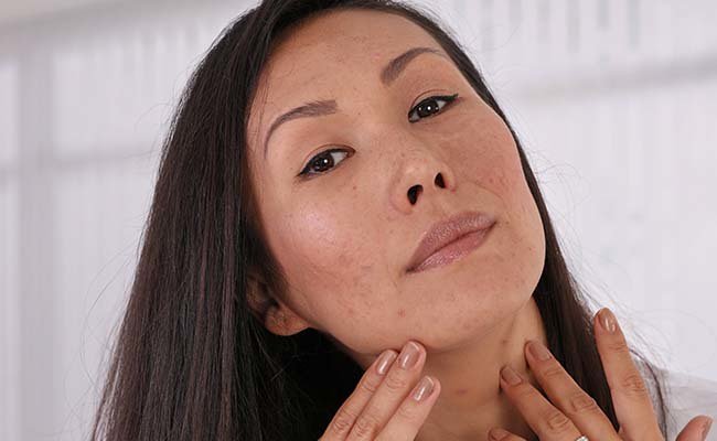 Did you know that according to research, adult acne is on the rise?  Here are some of the factors behind it:
care2.com/greenliving/wh…
#acne #beauty #skincare