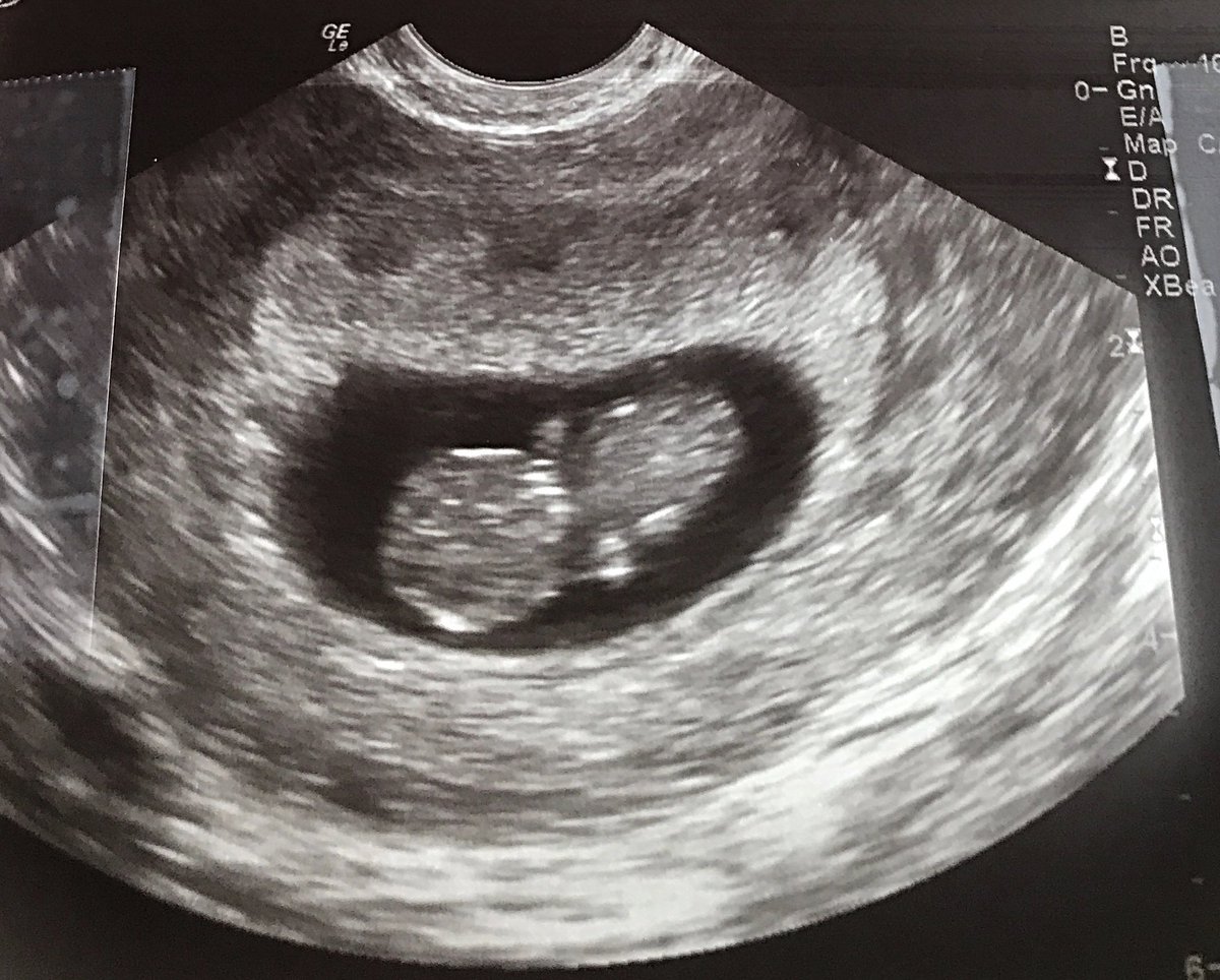 Jayy_Bee22's tweet photo. I believe life begins at conception. My sweet Carter’s value is not determined by his size. https://t.co/z18EbtYa9e
