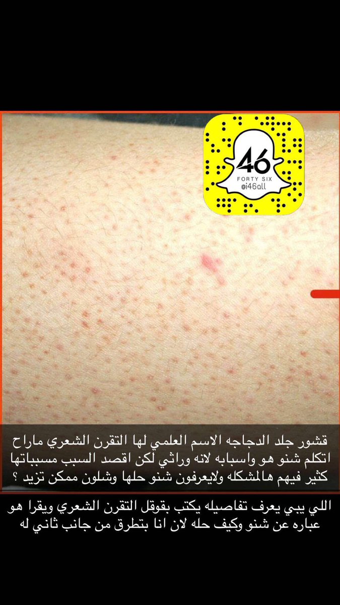 i46all's tweet photo. موضوع التقرن الشعري والحلاقه https://t.co/RqkhJRY6uS