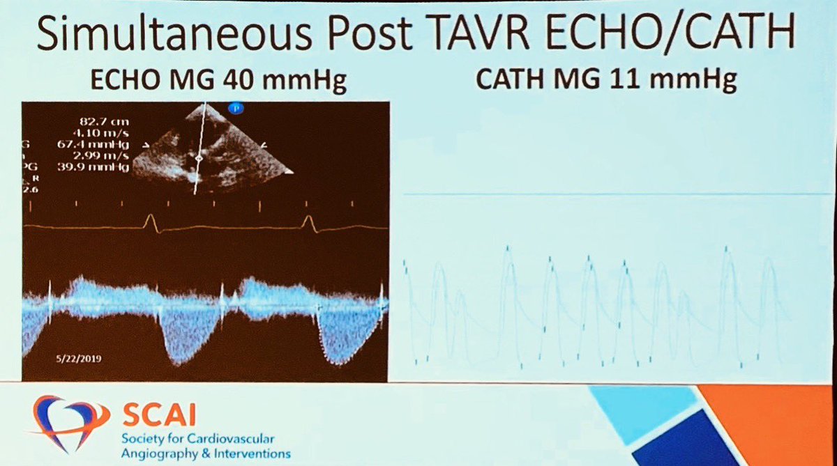 willsuh76's tweet image. Amr Abbas explaining cath vs echo mean gradient discrepancy in post #TAVR. Modified Bernoulli equation (4Vsquared) doesn’t account for pressure recovery, LVOT pressure, flow acceleration, viscous loss. #SCAI2019