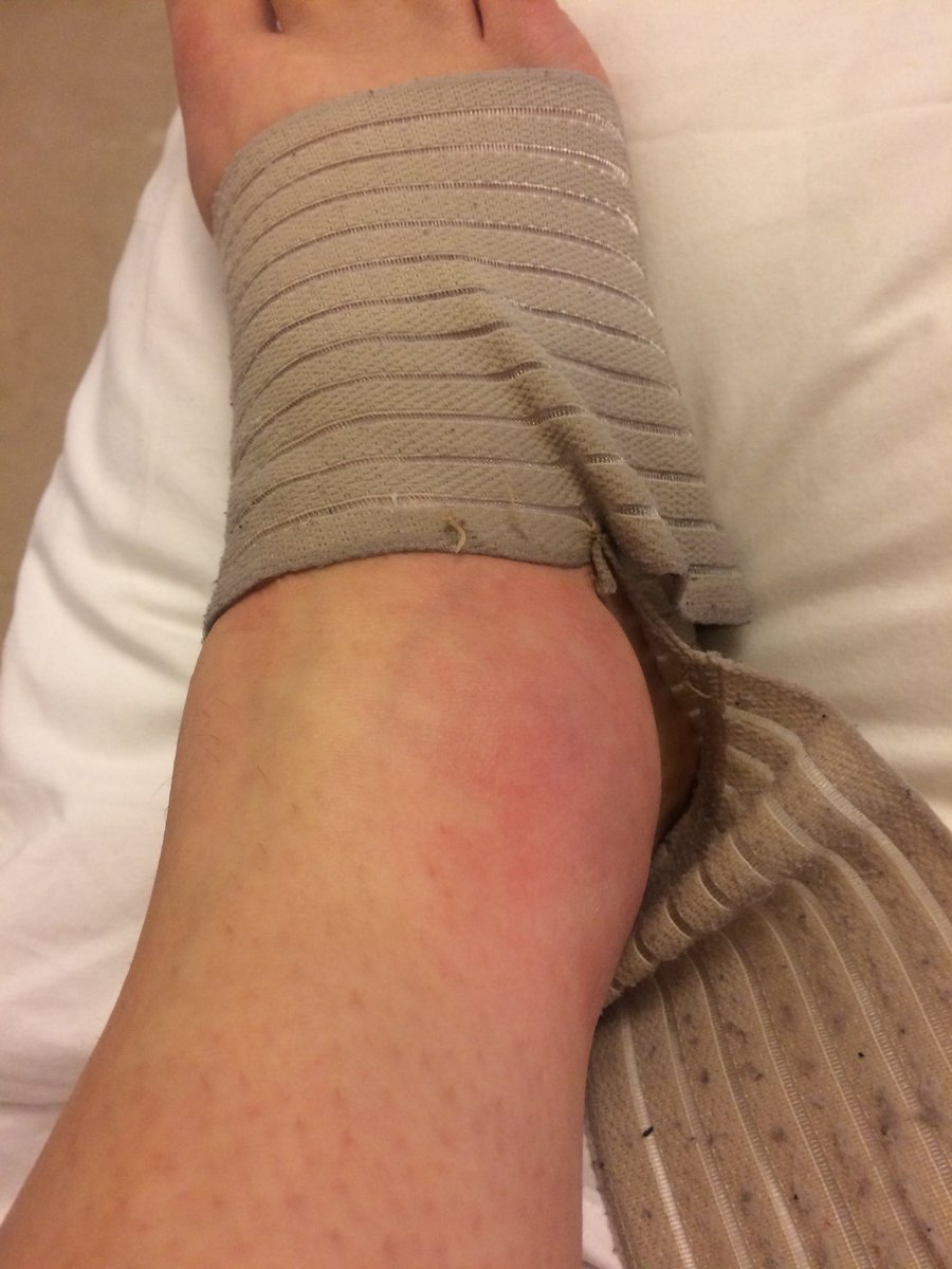 LoobyCoops's tweet image. Just getting into my stride and a pot hole did me in! #rest #elevation #ice #compression