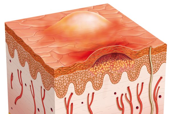 Источники бактериальных инфекций наружных покровов. Вхлдгын ворота инфекция. Исследование кожных покровов: методика. Инфекции наружных покровов примеры заболеваний. Дифтерия характерные клинические проявления.
