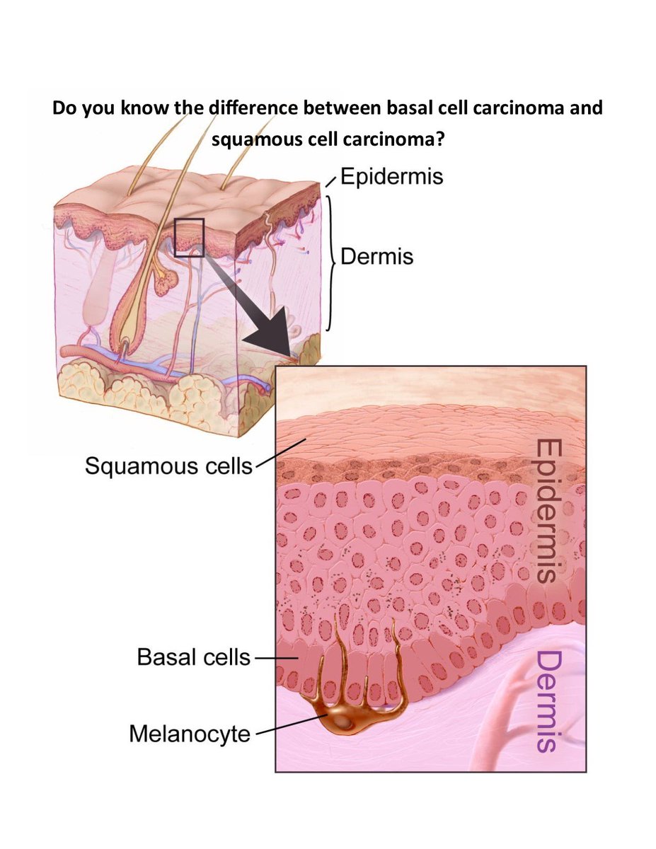LuxDermVisalia's tweet photo. Basal cell Carcinomas begins in the basal cells which are responsible for producing new skin cells. squamous cell carcinomas develops in the cells that make up the outer layer of the skin. SCCs are more likely to grow deeper into your skin and spread to other parts of your body. https://t.co/HmtiBqhDVA