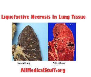 M y W a y on Twitter: "1-Liquefactive necrosis Our cells have enzymes that  can digest themselves. In liquefactive necrosis,these digestive enzymes  come into play, resulting in a liquified mass of dissolved