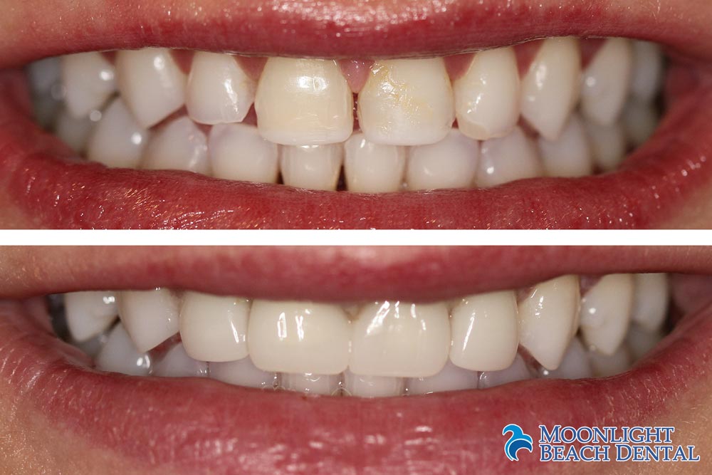 Moonlightbeachdental At Nicolevanedds Twitter