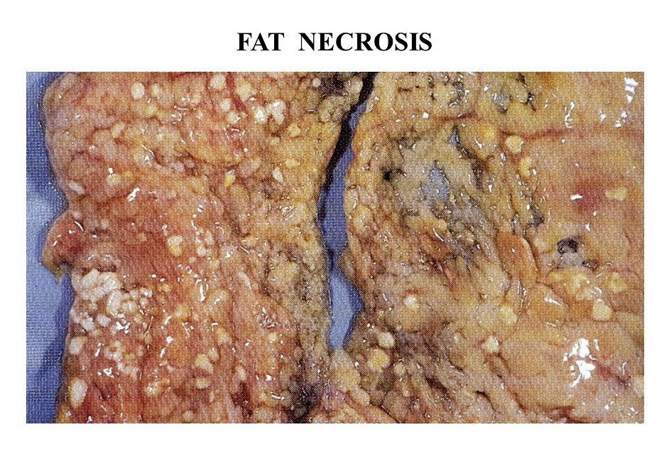 M y W a y on X: "5- Fat necrosis Adipocytes are specialized cells that  store energy in the form of fat. If necrosis occurs in a place that is rich  in