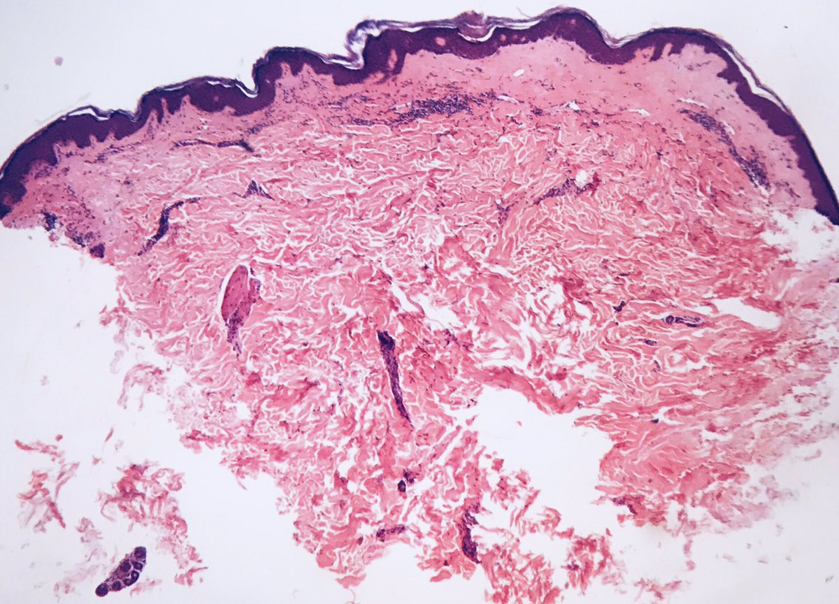 LizaAriasT's tweet photo. #LichenSclerosus Thin epidermis, loss of rete pegs, basal cell degeneration, homogenized band of dense fibrosis at papillary dermis, upper dermal edema, chronic inflammation around vessels,often band-like #Dermpath #LovingDermPath #PathArt #dermatopathology #Dermatopathologist https://t.co/gzOD8cDXFX