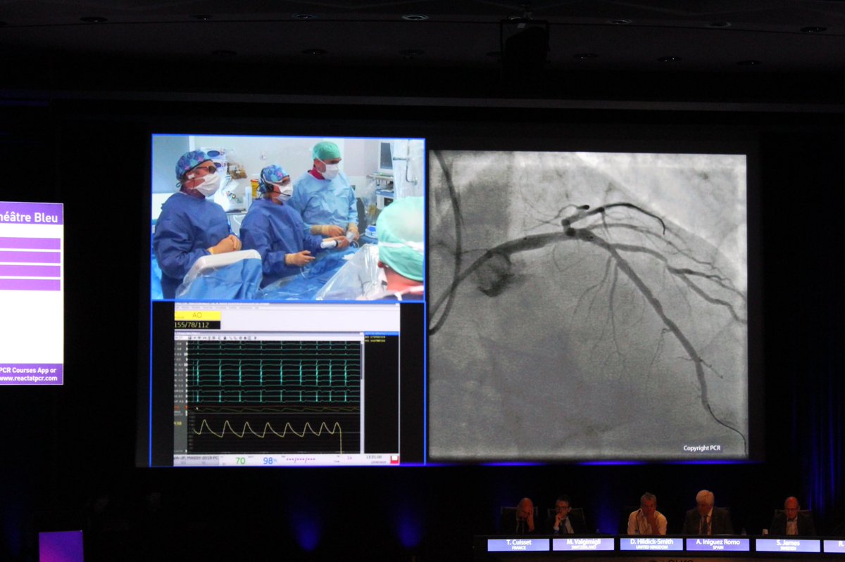 ICPS_institut's tweet photo. Second live case patient with a distal LM lesion . #ComplexPCI in high bleeding risk patients  #EuroPC #CardioTwitter #Cardiology #interventionnal @PCRonline @DrGarot @Chevalim240871 @DrThomasHovasse @DrthierryL @OnumaYoshinobu https://t.co/NLXiXLLnVE