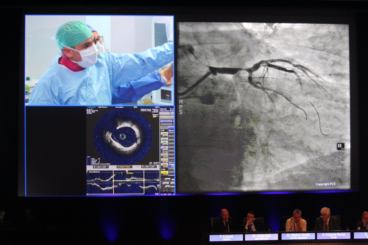 ICPS_institut's tweet photo. Second live case patient with a distal LM lesion . #ComplexPCI in high bleeding risk patients  #EuroPC #CardioTwitter #Cardiology #interventionnal @PCRonline @DrGarot @Chevalim240871 @DrThomasHovasse @DrthierryL @OnumaYoshinobu https://t.co/NLXiXLLnVE