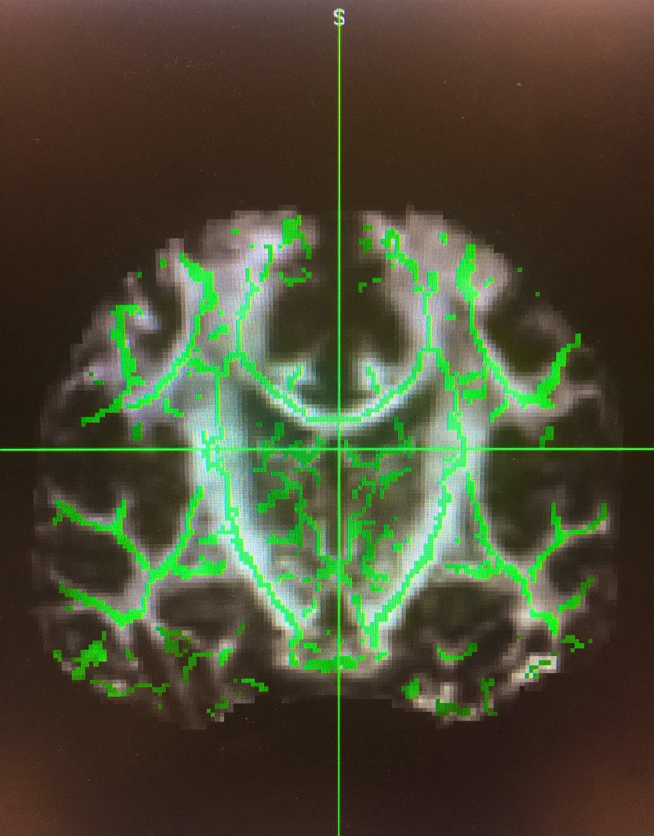 aemleenders's tweet photo. Super excited because of my first pilot analyses at the @DondersInst for my #MasterThesis #diffusionweightedimaging #DWI #neuroscience #Neuroimaging https://t.co/TE2r7AgTyl