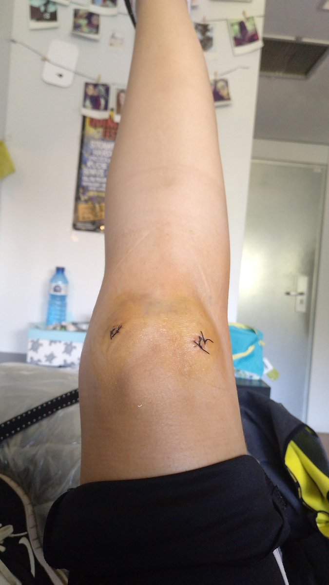 Hoy, después de una semana de la intervención, me quitan la venda 😊 ahora a esperar a que se seque un poco la herida y si todo va bien el lunes me quitan los puntos y en breves podré empezar con la musculación! 💪