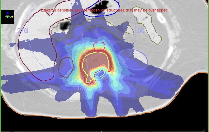 cpeedell's tweet photo. The beauty of modern radiotherapy: Being able to sculpt radiation dose around tumours to spare normal tissues is a remarkable testament to research physicists, mathematicians, computer scientists, engineers, dosimetrists, radiographers (&amp; clinicians!) #SpinalSBRT #VMAT #radonc https://t.co/fCSDUKFFzC