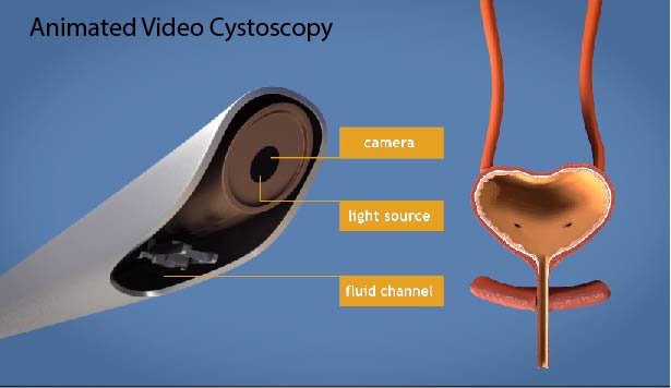 May is #BladderCancerAwarenessMonth. Blood in urine may be an indication of a bladder disease or #bladdercancer and reason enough to perform a #cystoscopy.

Watch our animated video about this diagnostic tool: patients.uroweb.org/video/cystosco…

@Uroweb @BladderCancerUK @cancereu