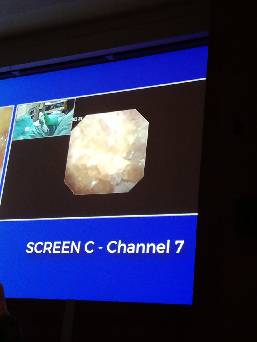 IMD Italian Medical Device (@imdsrl) on Twitter photo ➡️Chirurgia Intra Renale Retrograda eseguita dal Dottor Antonio Frattini con l'ureteroscopio monouso digitale flessibile <a href="/PusenMedical/">Pusen Medical</a>
👍Immagini nitide e #calcolorenale posizionato nel calice inferiore frammentato con laser moses @LumenisU
#IEA2019
#RIRS #livesurgery ➡️Chirurgia Intra Renale Retrograda eseguita dal Dottor Antonio Frattini con l'ureteroscopio monouso digitale flessibile <a href="/PusenMedical/">Pusen Medical</a>
👍Immagini nitide e #calcolorenale posizionato nel calice inferiore frammentato con laser moses @LumenisU
#IEA2019
#RIRS #livesurgery