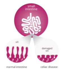 ImmusanT's tweet photo. What is #CeliacDisease? Celiac disease is a chronic inflammatory disease of the intestine caused by an #Autoimmune reaction to #Gluten proteins. To find out more about the disease, check out this link from @medlineplus: https://t.co/p44t3r3gwy #CeliacAwareness https://t.co/Ojjse0A5nX