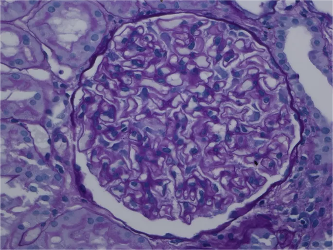 Case 5: A 52 year old woman with worsening lower extremity edema...

Navigate from the history to the end of the case where you can submit your final diagnosis! 

nephsim.com/case-5-introdu…

#FOAMed #MedEd #NephroticSyndrome