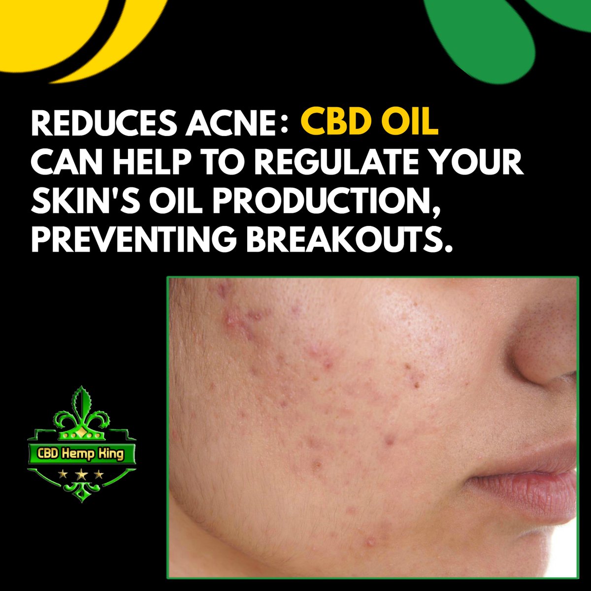 Reduces Acne: CBD Oil can help to regulate your skin's oil production, preventing breakouts.

#cbdhempking #hempflowers #cbdflowers #uk