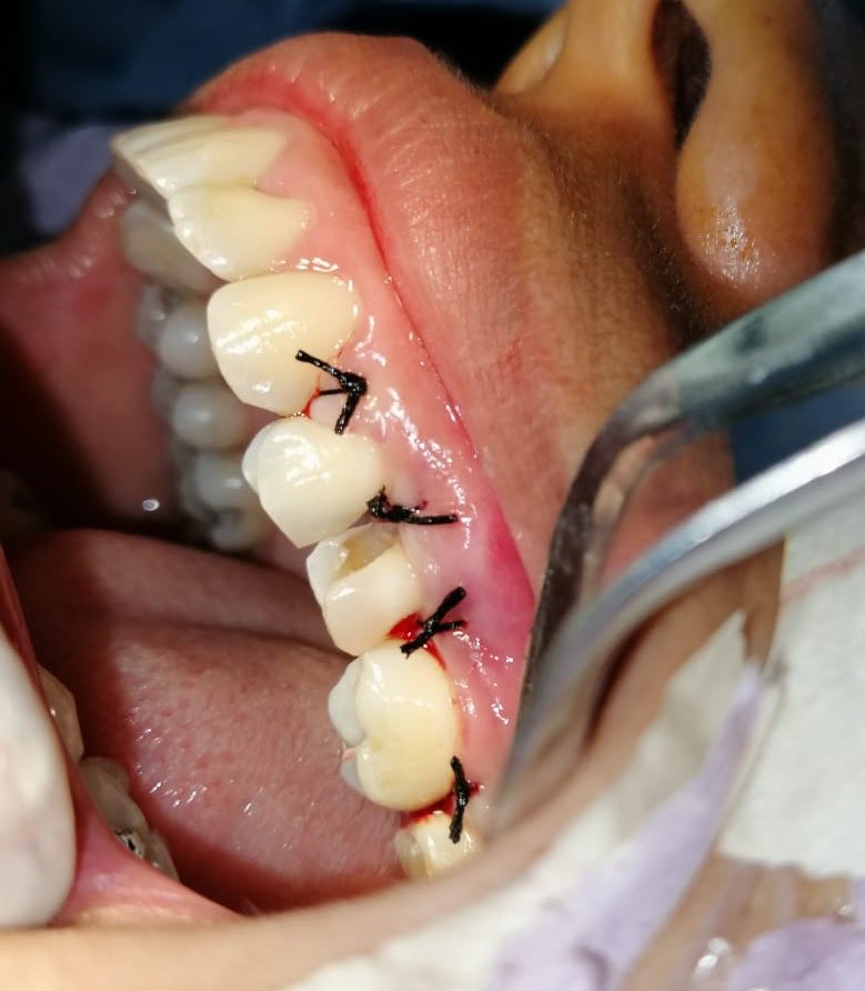 _selenagmz's tweet photo. Cirugía de alargamiento de corona clínica post Endodoncia #caries #subgingival ⚠️ https://t.co/1rtEvfn7QF