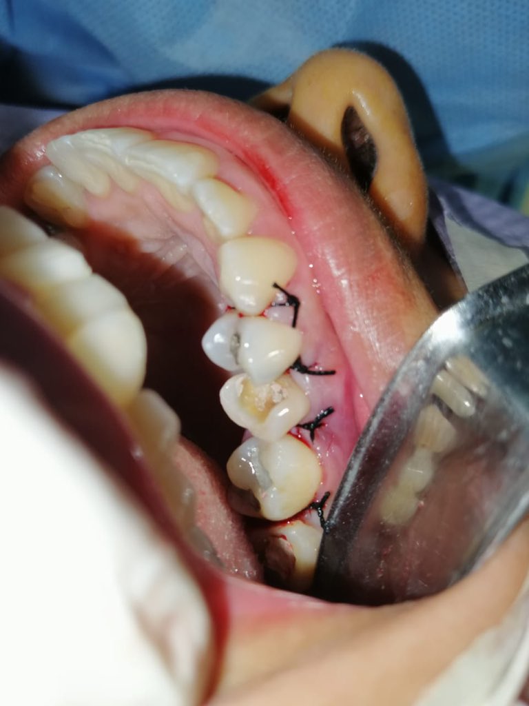 _selenagmz's tweet photo. Cirugía de alargamiento de corona clínica post Endodoncia #caries #subgingival ⚠️ https://t.co/1rtEvfn7QF