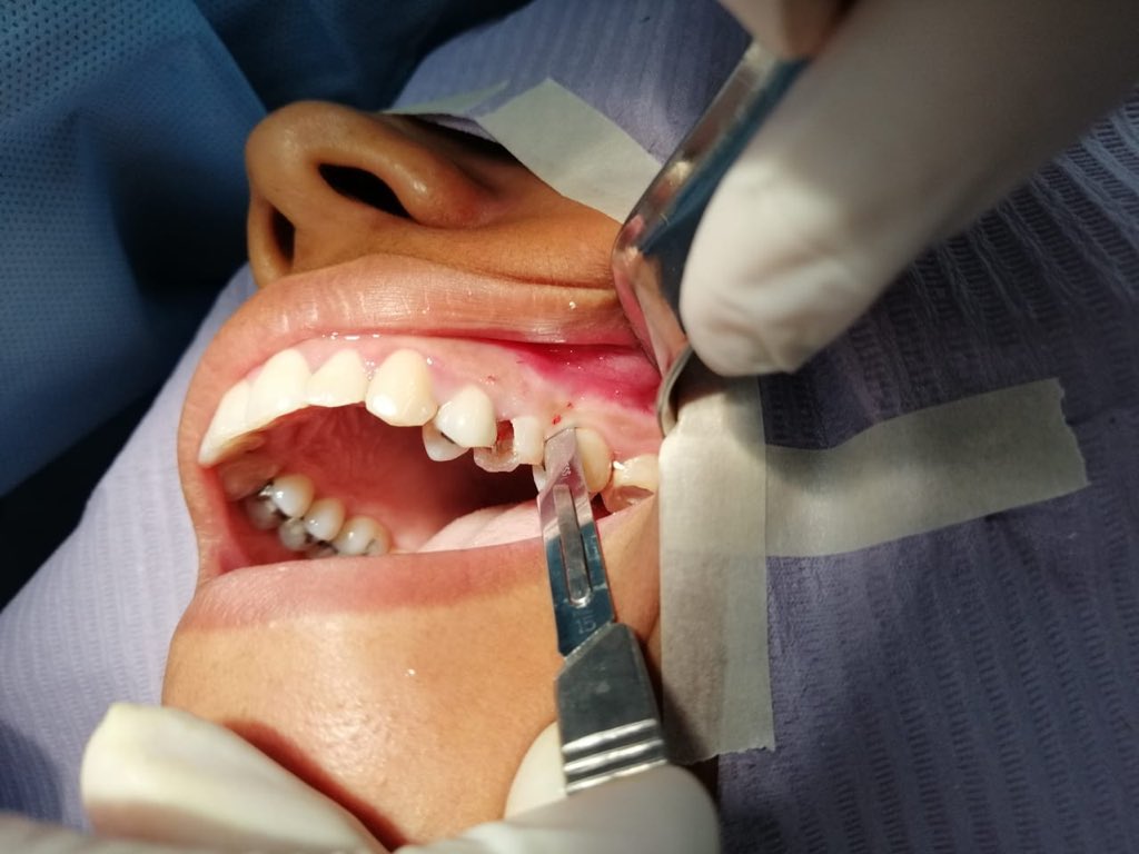 _selenagmz's tweet photo. Cirugía de alargamiento de corona clínica post Endodoncia #caries #subgingival ⚠️ https://t.co/1rtEvfn7QF