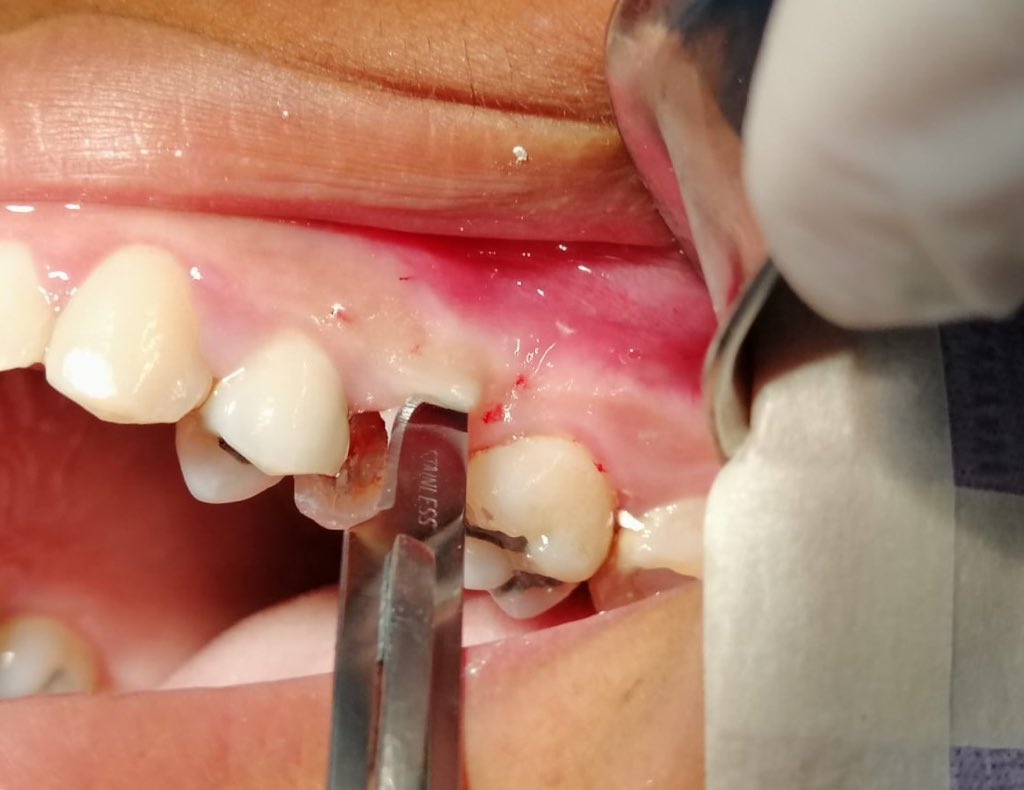 _selenagmz's tweet photo. Cirugía de alargamiento de corona clínica post Endodoncia #caries #subgingival ⚠️ https://t.co/1rtEvfn7QF