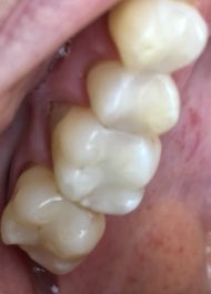 JerseyYs's tweet image. #ToothColouredFillings done in 2004 by #YsJersey.  It’s so lovely to see the longevity results of #HighSkill #QualityMaterials 
#QualityTechniques #QualityTime 
These #Fillings are 15 yrs old and still looking like new 😃