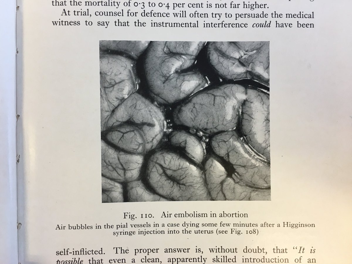 AsserThomsen's tweet image. Luftpropper i hjernen hos kvinde død efter illegal abort. Det var fast pensum i retsmedicin i gamle dage, før legalisering. Simpson’s Forensic Medicine 2nd, 1952.