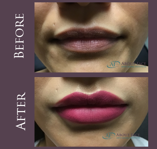 AFaceAntiAging's tweet photo. Absolutely gorgeous results  #Juvederm #FullLips #VolumizedLips #LipFillers #Beautiful https://t.co/DvrF9EYxCX