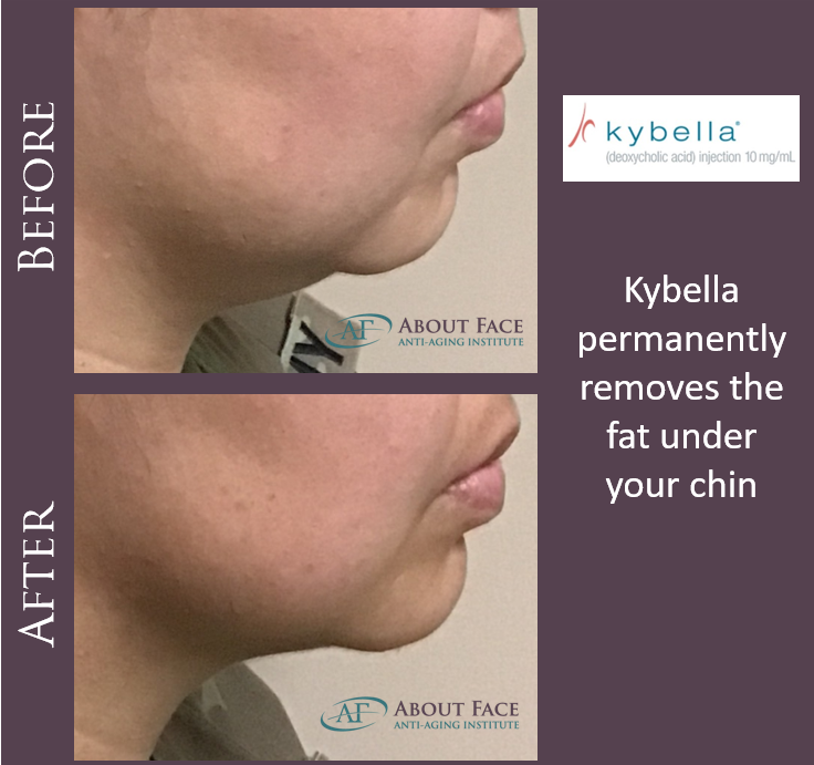 AFaceAntiAging's tweet photo. We helped this client get rid of her double chin. #Kybella #NoMoreDoubleChin #PermanentResults #KillsFatCells https://t.co/4BSgEGUScU