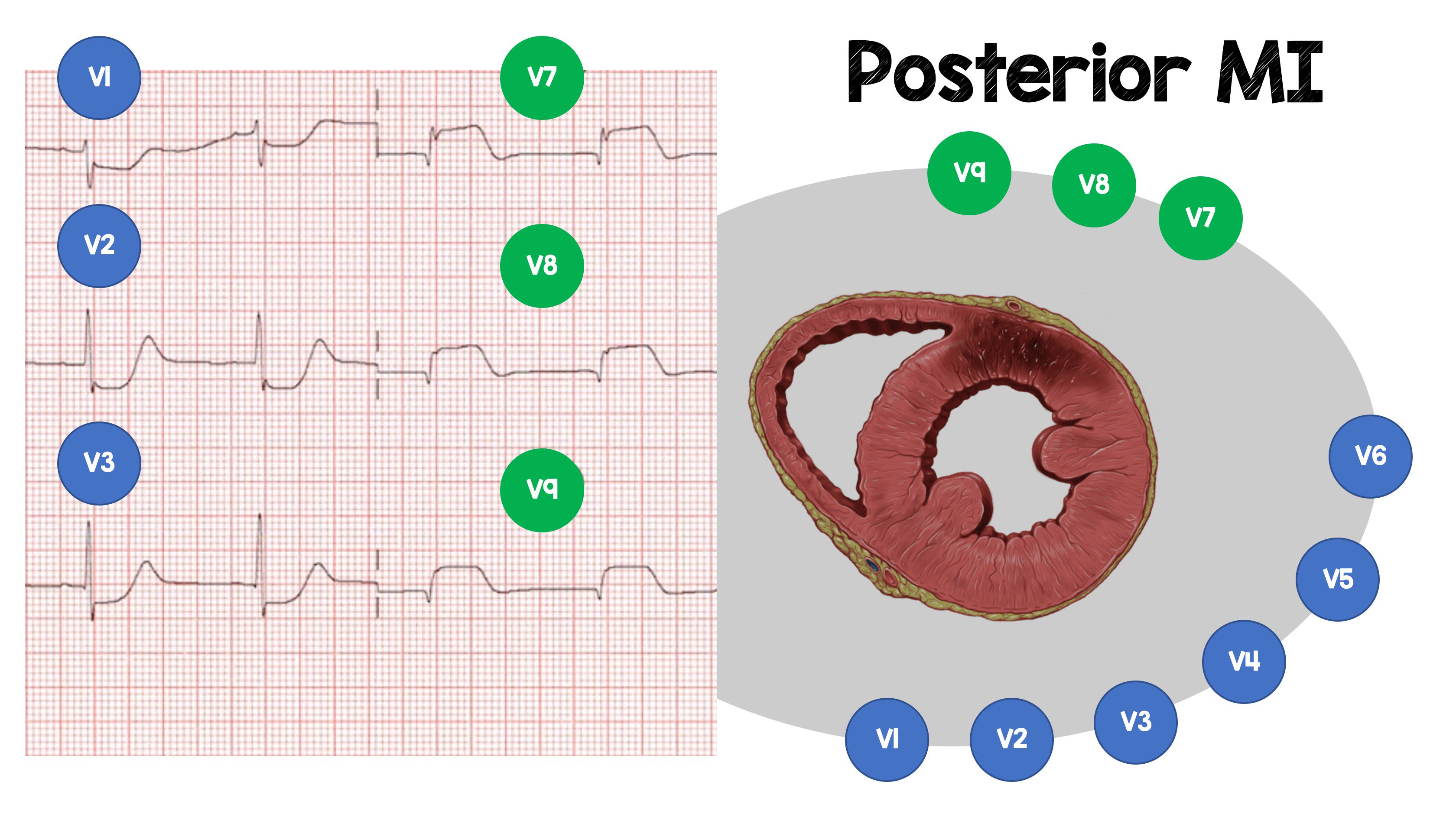 DSAE STEMI Review, Mod 1 RV Posterior STEMI Patterns, 55 OFF