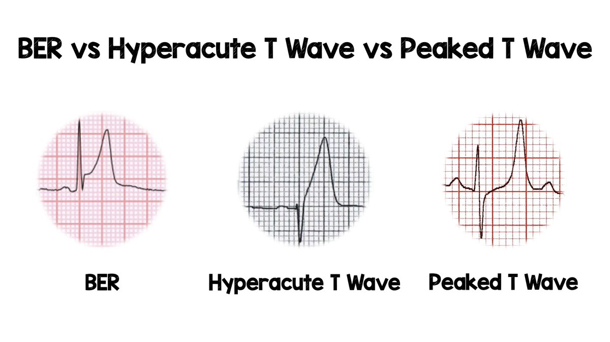 BER vs Hyperacute T Waves vs Peaked T Waves (HyperK+) <a href="/SATXFire/">SAFD</a> #ECG #EKG #corecontent

BER = Notching or slurring at J-point; Prominent, slightly asymmetric
Hyperacute T Wave = Disproportionally tall, broad
Peaked T Wave = Tall, narrow, symmetrically peaked