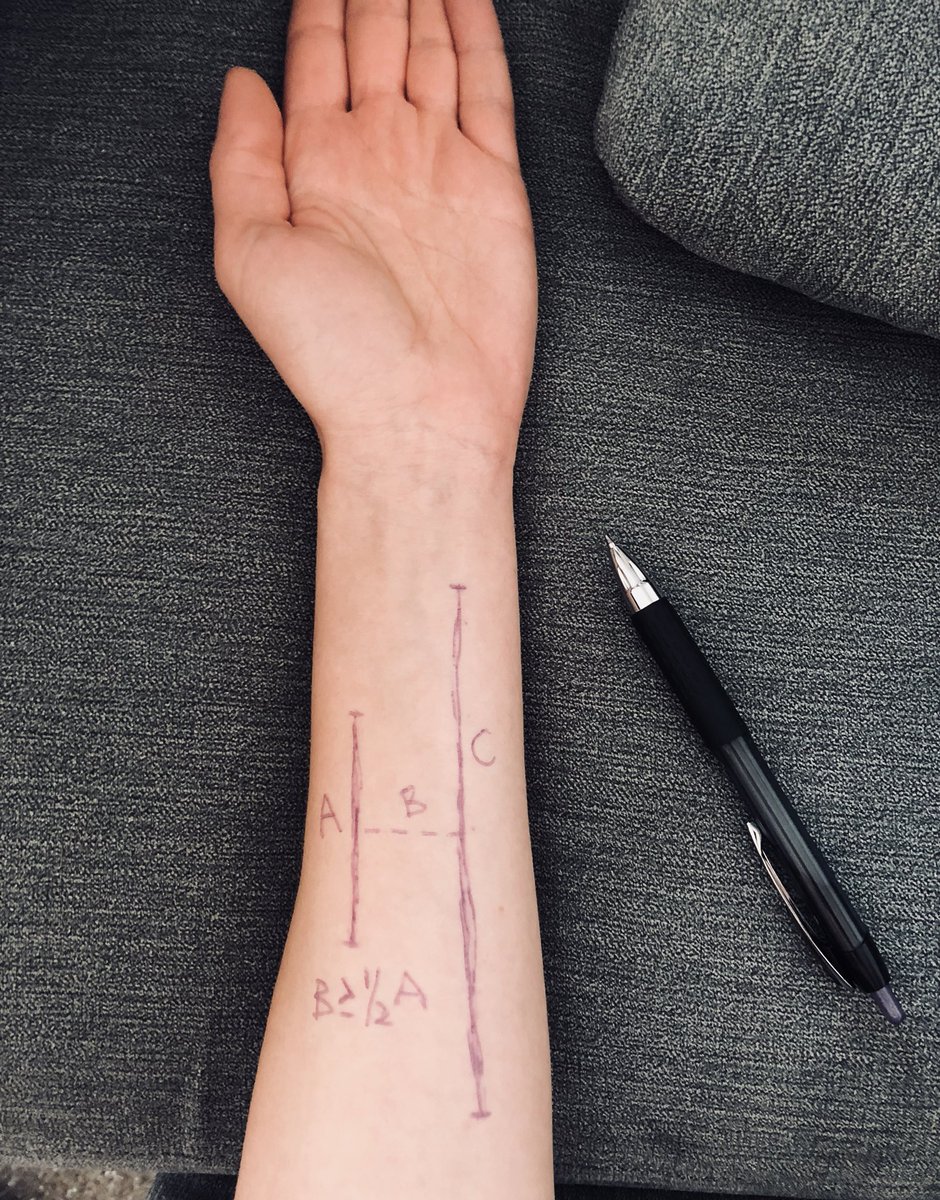 People ask me about rule for skin bridges. I drew it out. Line A is your first incision. As long as line B (skin bridge length) is half of line A or longer, it does not matter how long line C is. The skin bridge will survive. I have never had an issue. Now to wash off my arm 😂