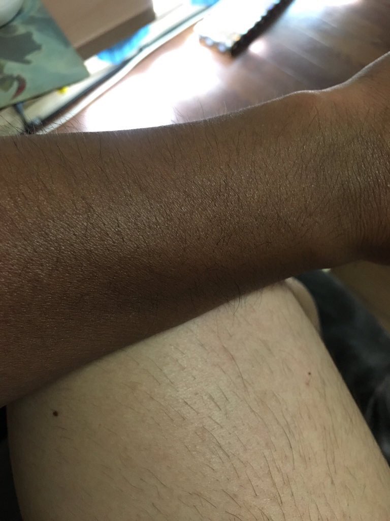 袖の長さが違うシャツを着る事により、日焼け跡にグラデーションがかかり、王将アイスみたいになるのも毎年の事です。去年は真っ黒になり過ぎてたので、友達に「一緒に歩くのちょっと嫌やったわ…」と言われました