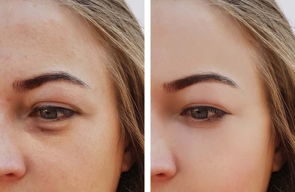 skin_flash's tweet photo. Causes for Puffy Eyes #puffyeyes #causesforpuffyeyes #puffyeyesremedies #eyeswelling https://t.co/MbOAfHK5dV https://t.co/XQfWJjxCoO