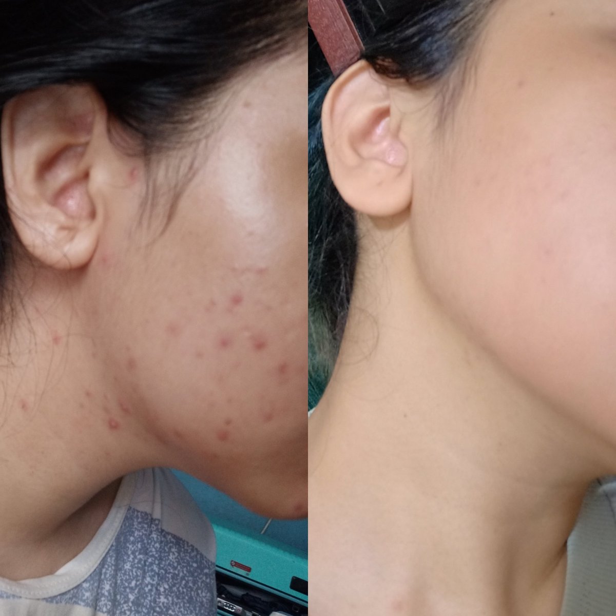 bucindalnim's tweet photo. Oke moots ku sayang. Aku mau curhat tentang:

   -PERJALANAN MUKA KU JADI AGAK MENDING KEK SEKARANG-

(( A THREAD )) https://t.co/YAZu8vN3YW