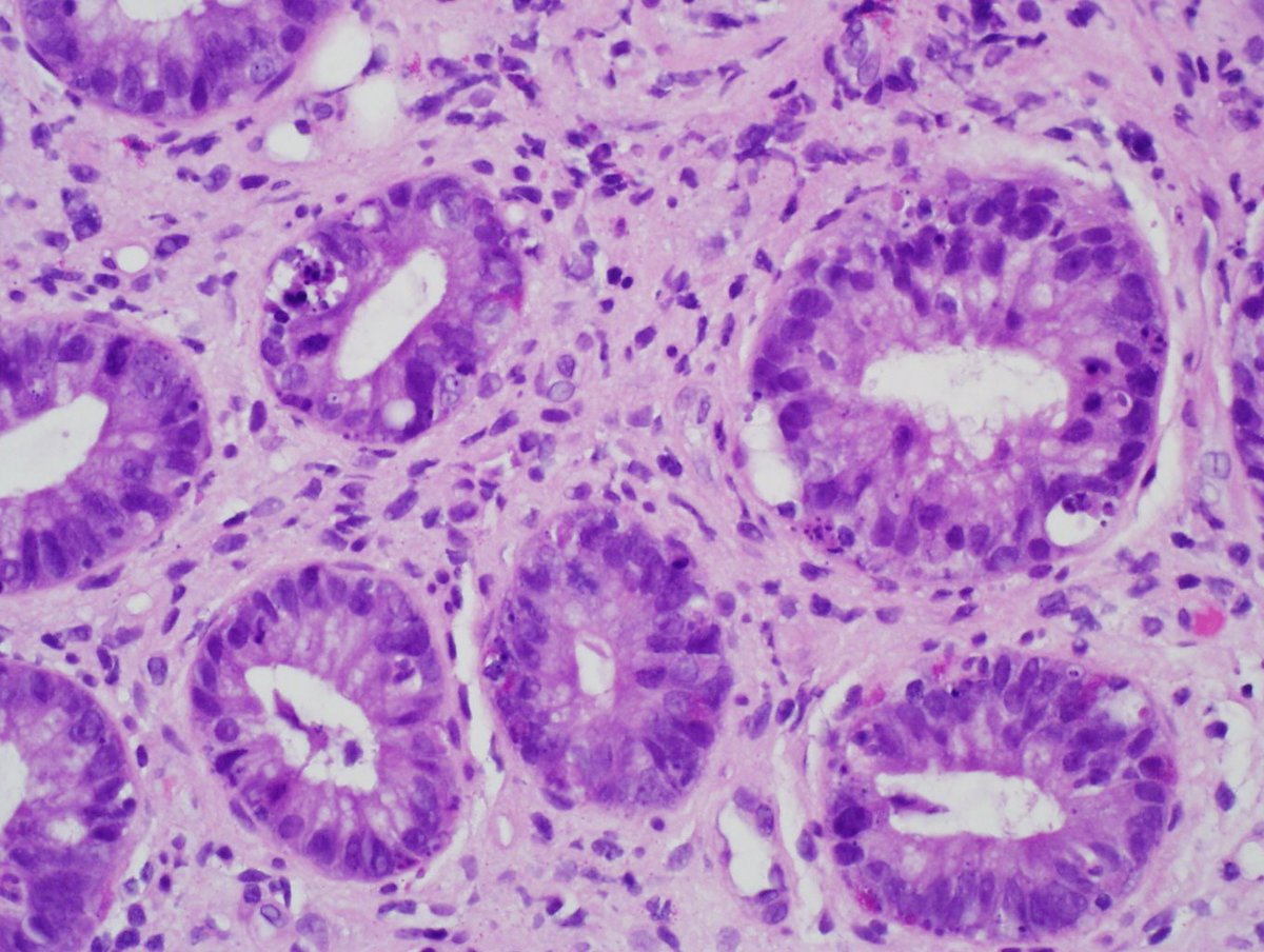 bit.ly/310cHje  FDA approves ruxolitinib for steroid-refractory acute GVHD in adult and pediatric patients 12 years and older. The recommended starting dose of ruxolitinib for GVHD is 5 mg given orally twice daily bit.ly/2MklWY4  <a href="/aGVHD/">Graft versus Host</a> <a href="/gvhd_hub/">GvHD Hub</a> @BldCancerDoc