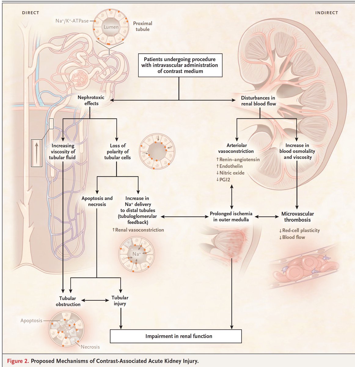 EricTopol's tweet photo. For decades, we thought IV fluids, certain contrast agents and acetylcysteine were the magic for avoiding kidney toxicity with angiograms. This @NEJM review by @Drroxmehran sets the record straight https://t.co/evDiE4YNCN @stevenweisbord @IcahnMountSinai https://t.co/8IbS4xfcfE