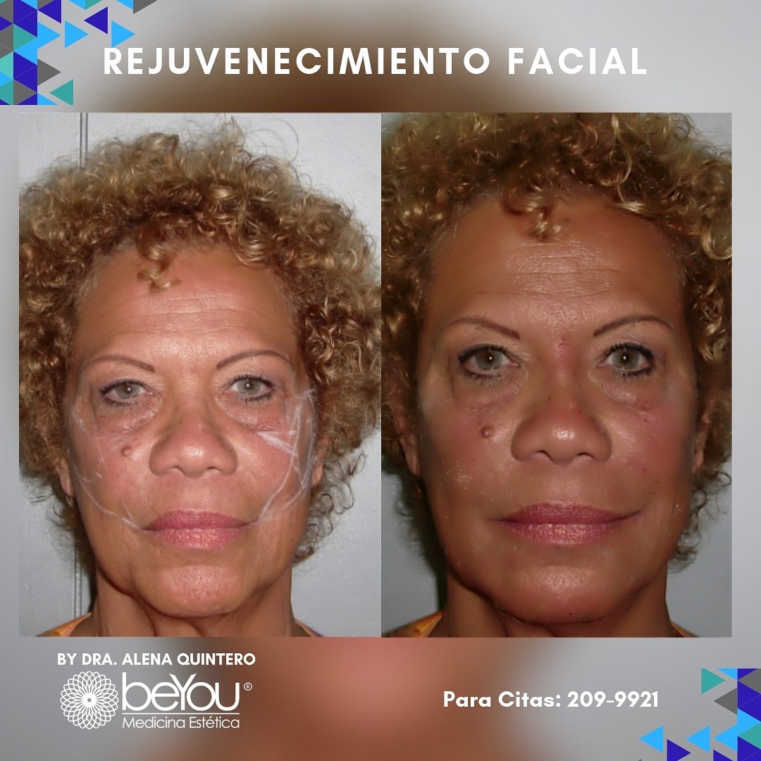 BeYouPanama's tweet photo. Verse rejuvenecida, sentirte mejor contigo misma, si te hace feliz porque no hacerlo 🤗 #rejuvenecimientofacial https://t.co/aAKkJU2rRO