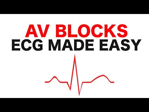 New post (The Three Types of AV Blocks ECG Made Easy) has been published on Nurseboards - nurseboards.com/groups/nursing…