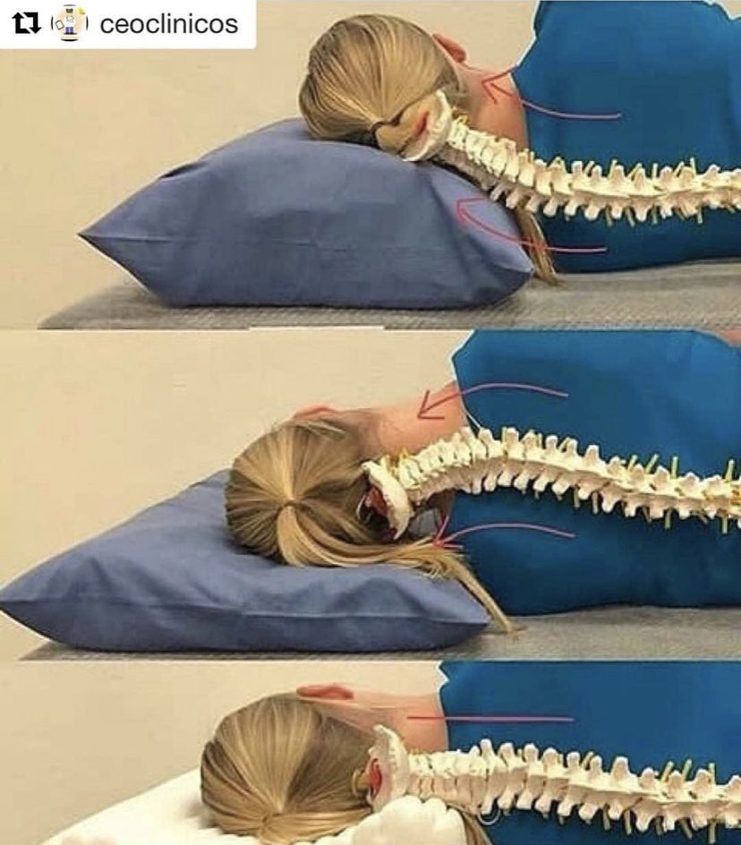 SimcoePhysio's tweet photo. The illustration below explains how the use of a pillow can affect the biomechanics of your spine.  Do yourself a favour and INVEST well!  

https://t.co/Y2kbiXHASy
705-250-6000

#southsimcoephysiotherapy #physio #newtecumseth #pillow #spine #biomechanics #painrelief #investment https://t.co/okOKRdNW7N