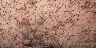 dermalicante's tweet photo. Los CONDILOMAS ACUMINADOS arruinan tu vida social. https://t.co/PhyVVaNY90 https://t.co/erP1DKwfUR