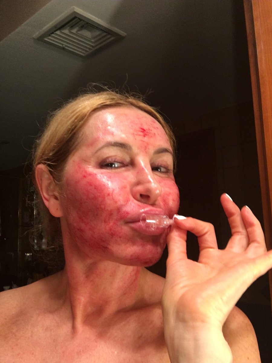 Marina_Oridel's tweet photo. Kiss Mesopen cartridge that gives me nice skin. No amount of creams,serums can do what this simple Medieval treatment can accomplish. Do this procedure regularly,have no fear, and rewards will be huge! #oridel #mesopen #skincare #aging #antiaging #menopause #beauty https://t.co/0SPugRzUuj